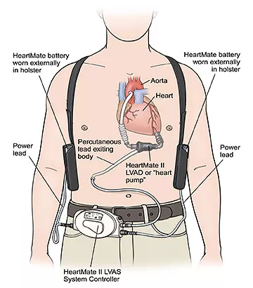 Heart Pump Device